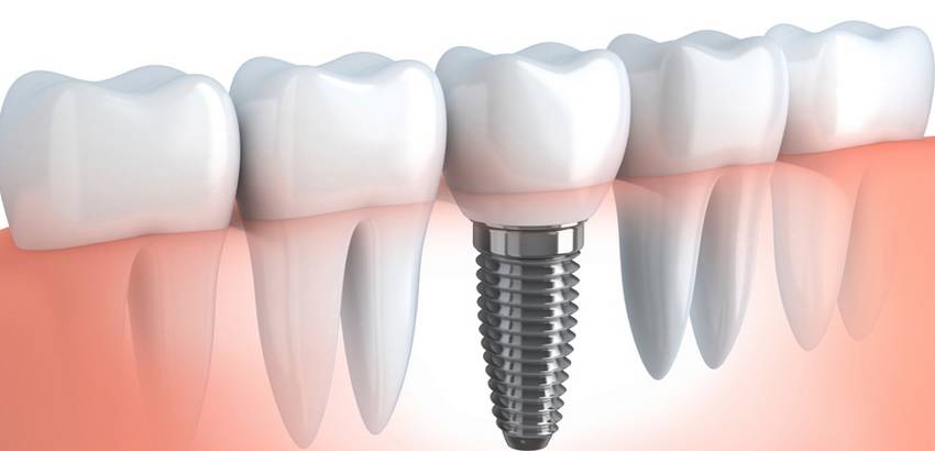Qu'est-ce qu'un implant dentaire